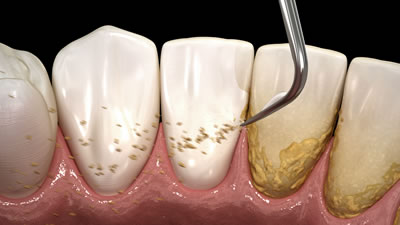 三鷹の歯医者｜ヒロ歯科クリニック｜武蔵境や吉祥寺からも通いやすい三鷹駅２分の歯科医院｜歯のクリーニング