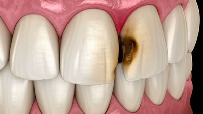 三鷹の歯医者｜ヒロ歯科クリニック｜武蔵境や吉祥寺からも通いやすい三鷹駅２分の歯科医院｜虫歯の治療と予防