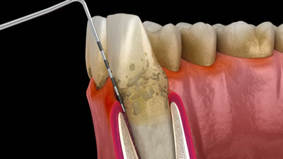 三鷹の歯医者｜ヒロ歯科クリニック｜武蔵境や吉祥寺からも通いやすい三鷹駅２分の歯科医院｜歯周病の治療と予防
