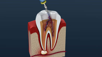 三鷹の歯医者｜ヒロ歯科クリニック｜武蔵境や吉祥寺からも通いやすい三鷹駅２分の歯科医院｜根管治療（歯根治療）