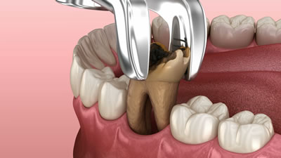 三鷹の歯医者｜ヒロ歯科クリニック｜武蔵境や吉祥寺からも通いやすい三鷹駅２分の歯科医院｜抜歯治療