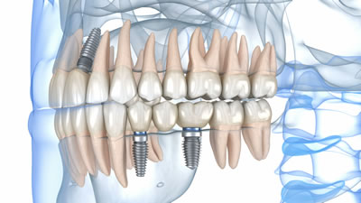 三鷹の歯医者｜ヒロ歯科クリニック｜武蔵境や吉祥寺からも通いやすい三鷹駅２分の歯科医院｜インプラント治療