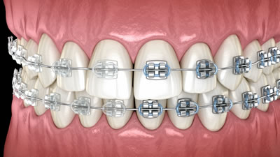 三鷹の歯医者｜ヒロ歯科クリニック｜武蔵境や吉祥寺からも通いやすい三鷹駅２分の歯科医院｜歯列矯正（歯並びの治療）