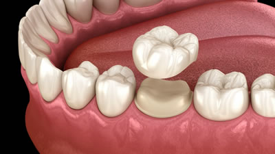 三鷹の歯医者｜ヒロ歯科クリニック｜武蔵境や吉祥寺からも通いやすい三鷹駅２分の歯科医院｜保険診療で歯を白くしたい
