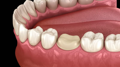 三鷹の歯医者｜ヒロ歯科クリニック｜武蔵境や吉祥寺からも通いやすい三鷹駅２分の歯科医院｜詰め物・被せ物・義歯（入れ歯）の不具合